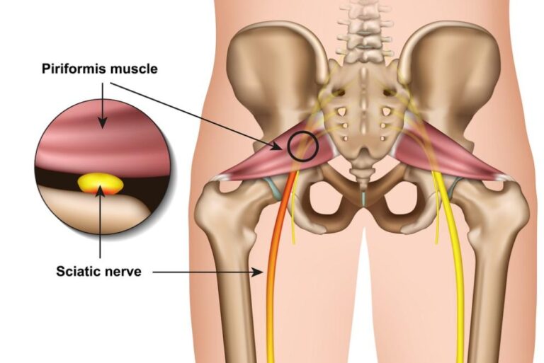 Sciatica & Piriformis Syndrome